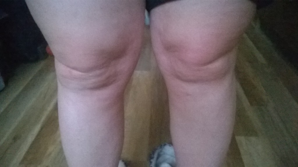 kolana mi ubytki tłuszczu na łydkach