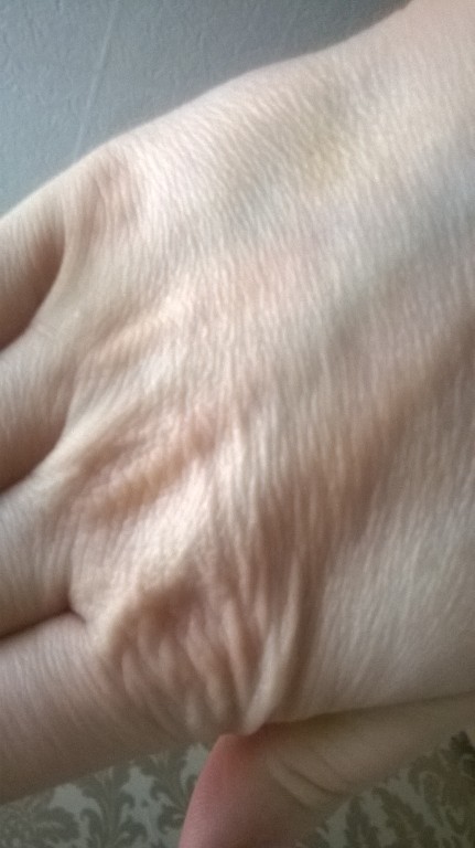 DŁONIE UBYTEK TŁUSZCZU